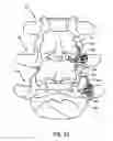 Fig. 35 - Spinal facet implants with mating articulating bearing surface and methods of use