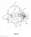 Fig. 45 - Spinal facet implants with mating articulating bearing surface and methods of use