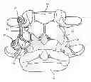 Fig. 01 - Linked bilateral spinal facet implants and methods of use