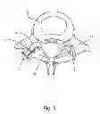 Fig. 07 - Linked bilateral spinal facet implants and methods of use