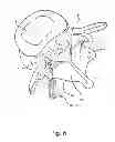 Fig. 09 - Linked bilateral spinal facet implants and methods of use
