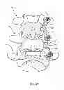 Fig. 35 - Linked bilateral spinal facet implants and methods of use