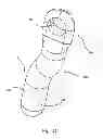 Fig. 41 - Linked bilateral spinal facet implants and methods of use