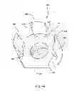 Fig. 45 - Linked bilateral spinal facet implants and methods of use