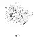 Fig. 49 - Linked bilateral spinal facet implants and methods of use