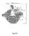 Fig. 63 - Linked bilateral spinal facet implants and methods of use