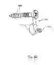 Fig. 72 - Linked bilateral spinal facet implants and methods of use