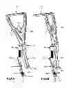 Fig. 08 - Bi-planar persuader