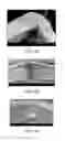 Fig. 12 - Crush recoverable polymer scaffolds