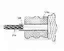 Fig. 01 - SELECTIVELY COATING LUMINAL SURFACES OF STENTS