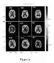 Fig. 12 - MRI detection of tissue macromolecular characteristics using MTC effects