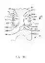 Fig. 06 - Damped dual stage actuation disk drive suspensions