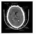 Fig. 01 - NOVEL DEVICE FOR MARKING LOCATION OF ORGANS ON SKIN AS PER CAT SCAN