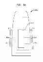 Fig. 06 - Removable attachment of a passive transcutaneous bone conduction device with limited skin deformation