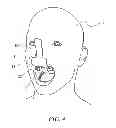 Fig. 04 - INTRAORAL MAXRETRACTOR
