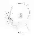 Fig. 05 - INTRAORAL MAXRETRACTOR