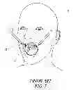 Fig. 07 - INTRAORAL MAXRETRACTOR