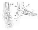 Fig. 01 - FOOT IMPLANT AND METHOD FOR TREATING A FOOT