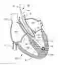 Fig. 01 - ANATOMIC DEVICE DELIVERY AND POSITIONING SYSTEM AND METHOD OF USE