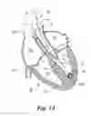 Fig. 06 - ANATOMIC DEVICE DELIVERY AND POSITIONING SYSTEM AND METHOD OF USE