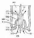 Fig. 01 - Inflatable medical devices