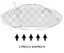 Fig. 01 - Device and procedure to treat presbyopia