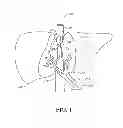 Fig. 02 - Gastroduodenal artery neuromodulation