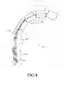 Fig. 09 - Gastroduodenal artery neuromodulation