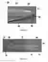 Fig. 03 - Spinal cord stimulation system