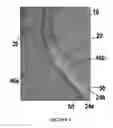 Fig. 05 - Spinal cord stimulation system