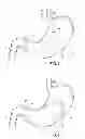 Fig. 02 - INTRAGASTRIC BALLOON SHELL MATERIALS AND CONSTRUCTION