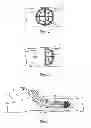Fig. 06 - ENDOVASCULAR MEDICAL SYSTEM INCLUDING EXPANDABLE AND COLLAPSIBLE FRAMEWORK AND METHOD USING SAME
