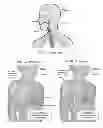 Fig. 02 - Protecting airways