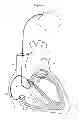 Fig. 02 - His bundle lead delivery system