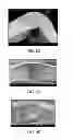 Fig. 12 - Crush Recoverable Polymer Scaffolds