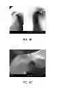 Fig. 13 - Crush Recoverable Polymer Scaffolds
