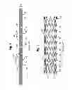 Fig. 02 - Bend-capable stent prosthesis