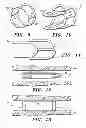 Fig. 04 - Vascular prosthesis