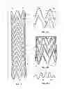 Fig. 02 - ELECTROSPUN PTFE COATED STENT AND METHOD OF USE