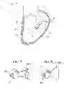 Fig. 03 - Heart Valve Sealing Devices