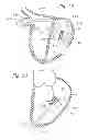 Fig. 10 - Heart Valve Sealing Devices
