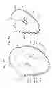 Fig. 16 - Heart Valve Sealing Devices
