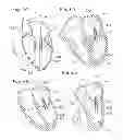 Fig. 26 - Heart Valve Sealing Devices