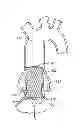 Fig. 01 - Integrated Dilation Balloon and Valve Prosthesis Delivery System