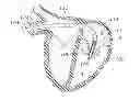Fig. 01 - Heart valve sealing devices