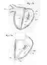 Fig. 10 - Heart valve sealing devices