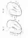Fig. 15 - Heart valve sealing devices
