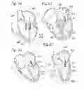 Fig. 26 - Heart valve sealing devices