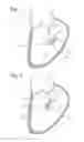 Fig. 02 - Heart valve sealing devices