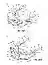 Fig. 35 - Ventricular cuff